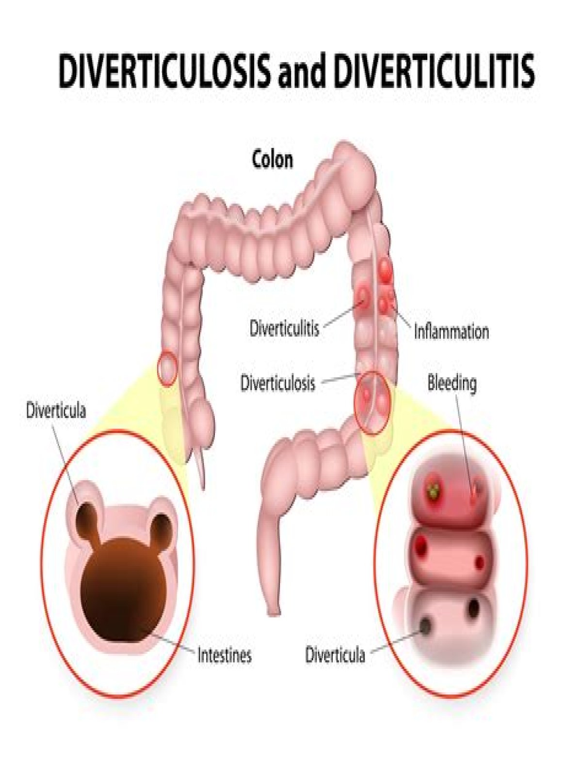 Can you get diverticulitis after colon resection?