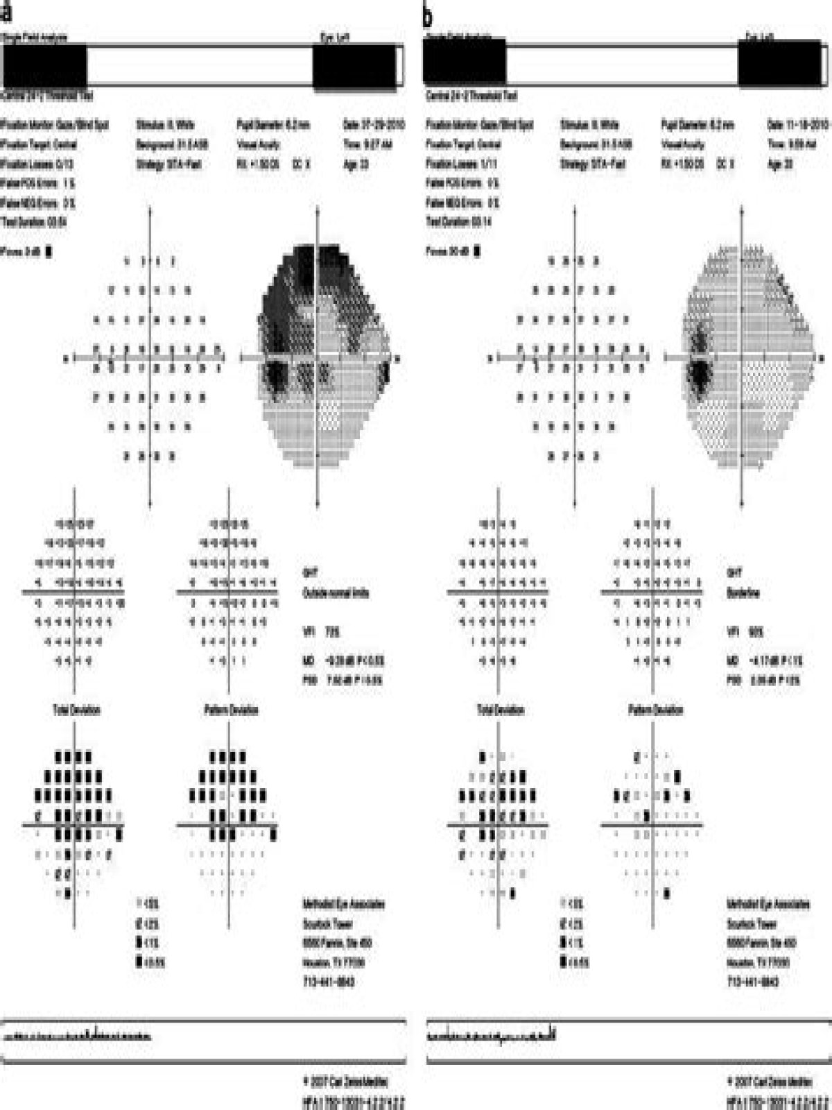 What is arcuate defect?